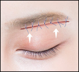 눈썹거상술 시술 3단계