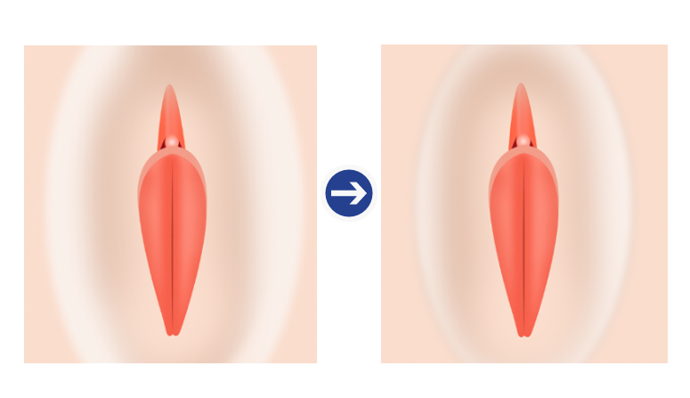 대음순 성형 축소술