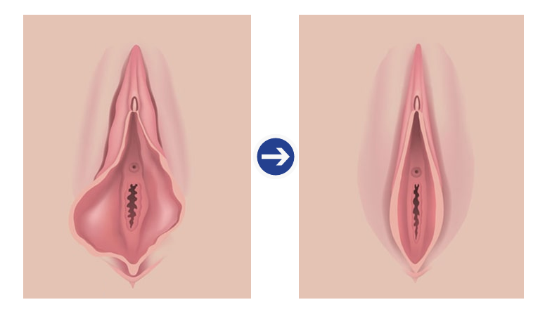 대음순 성형 확대술