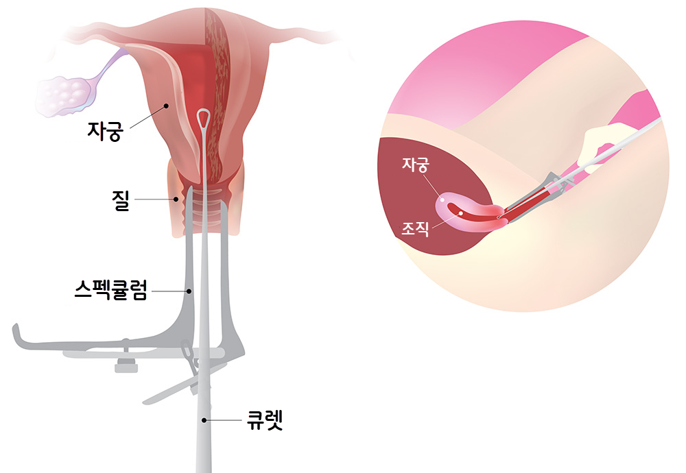 자궁소파수술 진행과정