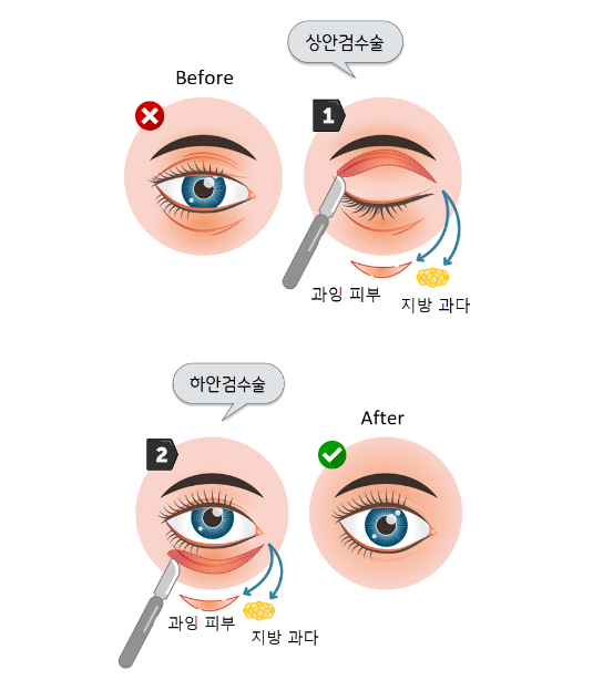 상안검수술 vs 하안검수술