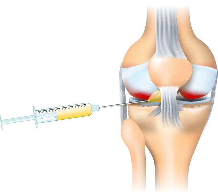 연골재생 주사