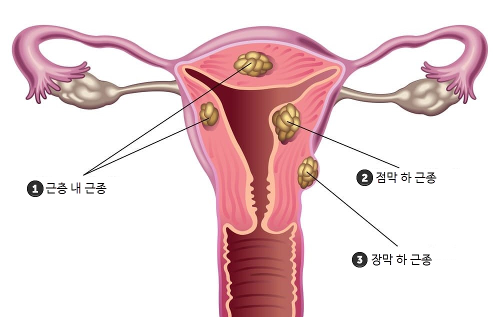 자궁근종의 종류