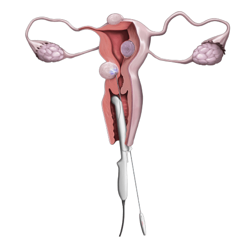 자궁근종 용해술 치료법