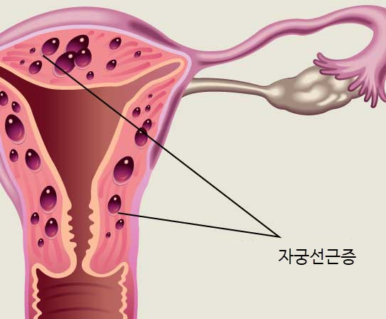 자궁선근증