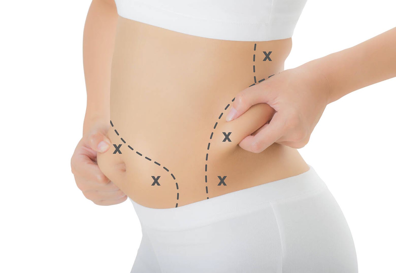 How Liposuction Tumescent Surgery Works