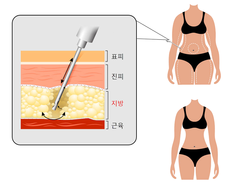 지방흡입슬