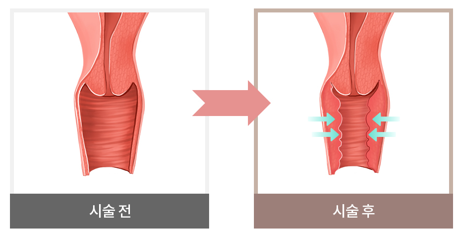 질성형 수술