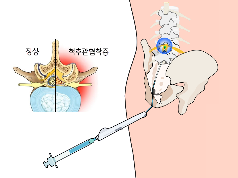 풍선확장 신경성형술