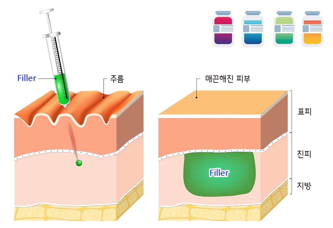 필러 시술과정