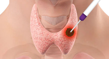 갑상선 고주파 절제술 시술과정 2단계