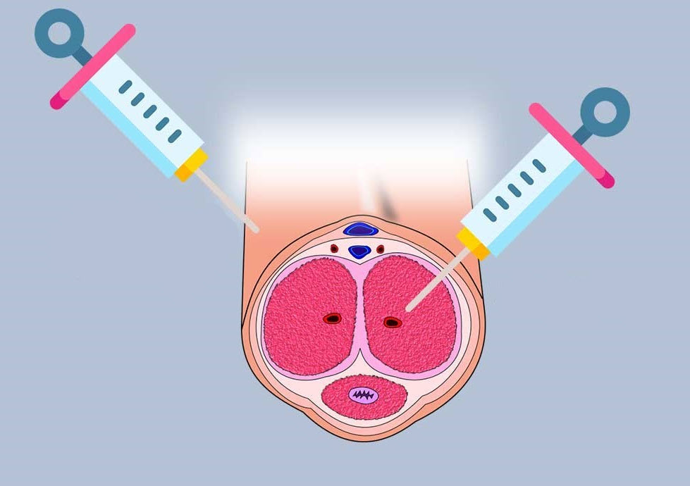 줄기세포 치료 남성 성기능 개선